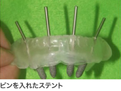 ピンを入れたステント