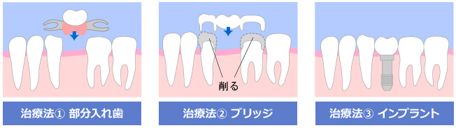 歯が抜けたところに行う治療は、3つあります。